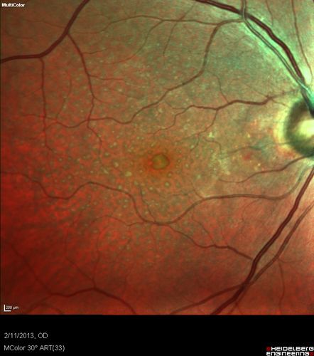 Asymptomatic Juxtapapillary Choroidal Neovascular Membrane - Reticular Macular Disease (Wet AMD)  - Heidelberg Color
