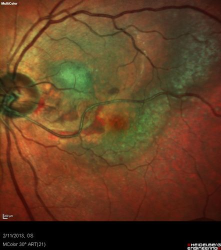 Asymptomatic Juxtapapillary Choroidal Neovascular Membrane - Reticular Macular Disease (Wet AMD)  - Heidelberg Color
