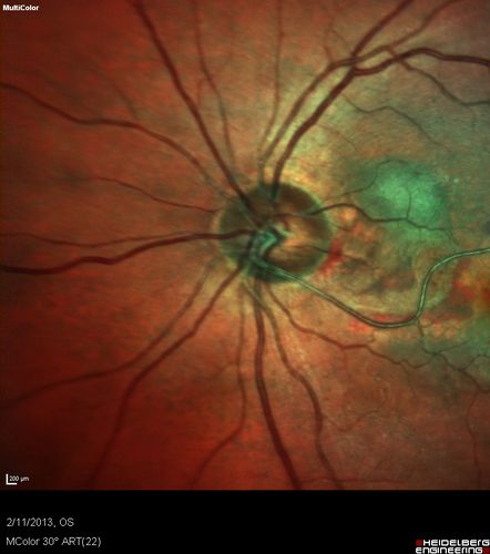 Asymptomatic Juxtapapillary Choroidal Neovascular Membrane - Reticular Macular Disease (Wet AMD) - Heidelberg Color
