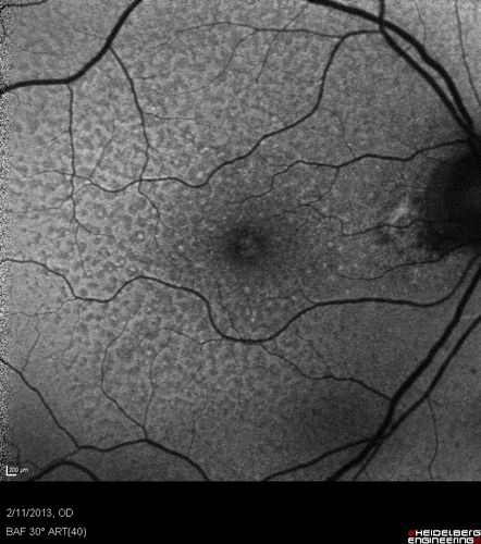 Asymptomatic Juxtapapillary Choroidal Neovascular Membrane - Reticular Macular Disease (Wet AMD) - FAF
