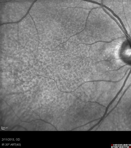 Asymptomatic Juxtapapillary Choroidal Neovascular Membrane - Reticular Macular Disease (Wet AMD) 
