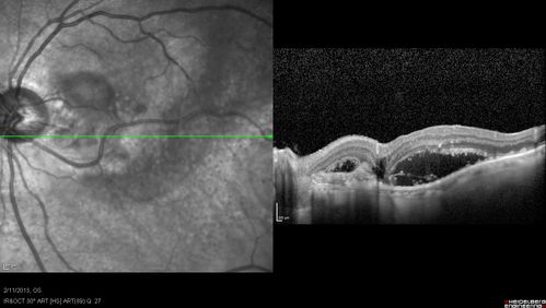 Asymptomatic Juxtapapillary Choroidal Neovascular Membrane - Reticular Macular Disease (Wet AMD) 
