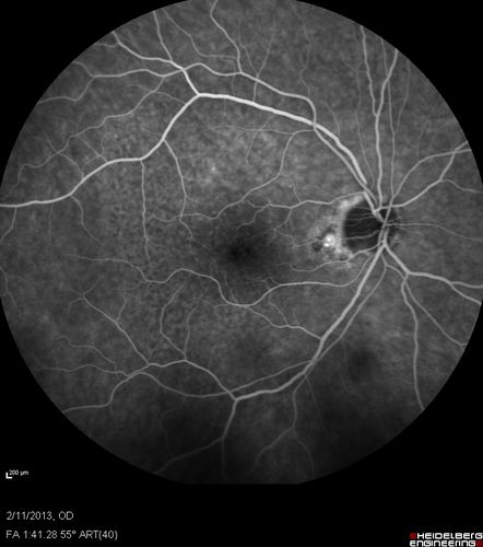 Asymptomatic Juxtapapillary Choroidal Neovascular Membrane - Reticular Macular Disease (Wet AMD) 
