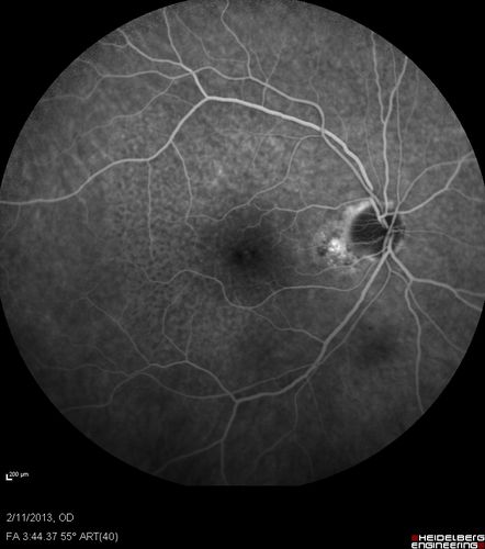 Asymptomatic Juxtapapillary Choroidal Neovascular Membrane - Reticular Macular Disease (Wet AMD) 
