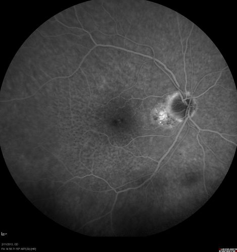 Asymptomatic Juxtapapillary Choroidal Neovascular Membrane - Reticular Macular Disease (Wet AMD) 
