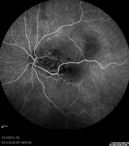 Asymptomatic Juxtapapillary Choroidal Neovascular Membrane - Reticular Macular Disease (Wet AMD) 
