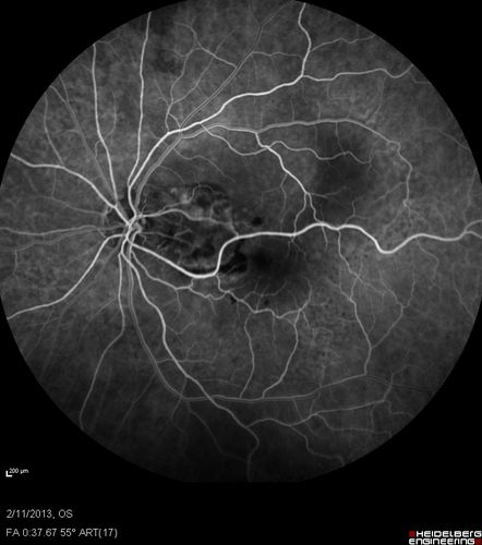 Asymptomatic Juxtapapillary Choroidal Neovascular Membrane - Reticular Macular Disease (Wet AMD) 
