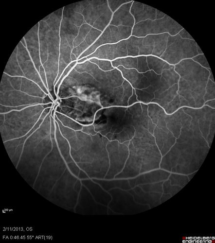 Asymptomatic Juxtapapillary Choroidal Neovascular Membrane - Reticular Macular Disease (Wet AMD) 

