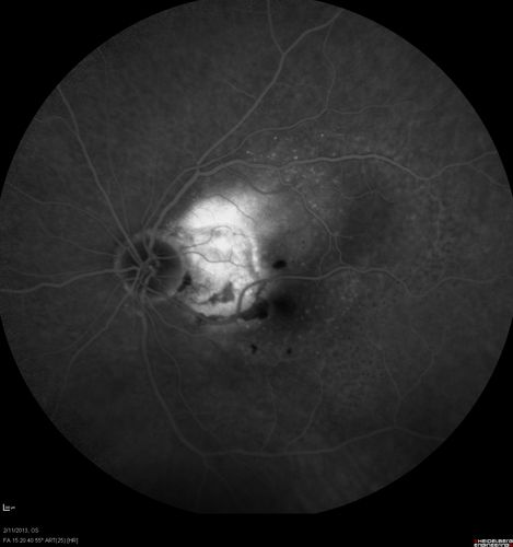 Asymptomatic Juxtapapillary Choroidal Neovascular Membrane - Reticular Macular Disease (Wet AMD) 
