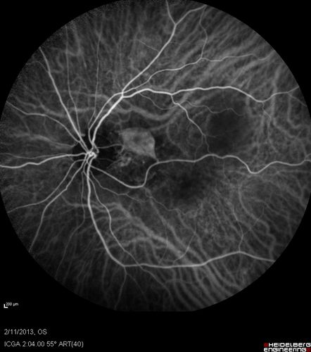 Asymptomatic Juxtapapillary Choroidal Neovascular Membrane - Reticular Macular Disease (Wet AMD) 
