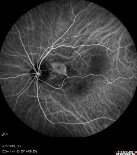 Asymptomatic Juxtapapillary Choroidal Neovascular Membrane - Reticular Macular Disease (Wet AMD) 
