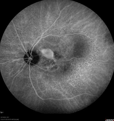 Asymptomatic Juxtapapillary Choroidal Neovascular Membrane - Reticular Macular Disease (Wet AMD) 
