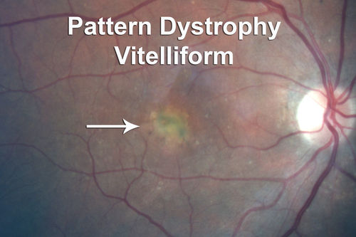 Adult Vitelliform Macular Dystrophy - Pattern Dystrophy
