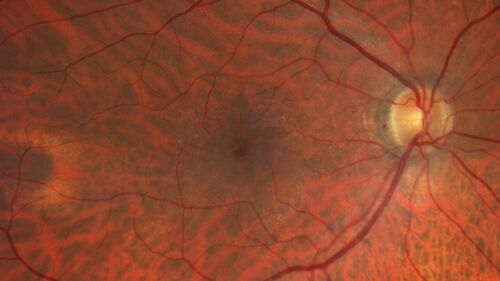 Lamellar Macular Hole - Evoluation over 5 years
65 year old man with Sturge weber and a choroidal hemangioma in the left eye.  (See other images under sturge weber on this website). Has ongoing problem with his left eye.  Now with Blurred vision in the right eye gradually worse the last few weeks.  He has had a vitrectomy in the right eye 4 years ago for floaters.  Laser for tears and cryo in the right eye 5 years ago. He is on Dorzolamide and Lumigan for glaucoma.
VA 20/32 OD, 20/40 OS
IOP 23 OD, 19 OS
