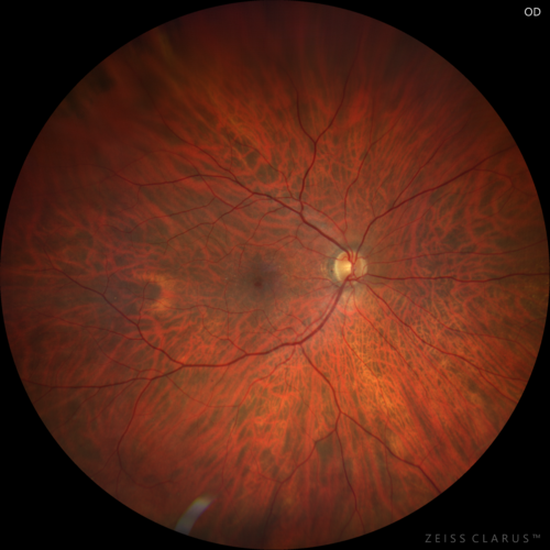 Lamellar Macular Hole - Evoluation over 5 years
65 year old man with Sturge weber and a choroidal hemangioma in the left eye.  (See other images under sturge weber on this website). Has ongoing problem with his left eye.  Now with Blurred vision in the right eye gradually worse the last few weeks.  He has had a vitrectomy in the right eye 4 years ago for floaters.  Laser for tears and cryo in the right eye 5 years ago. He is on Dorzolamide and Lumigan for glaucoma.
VA 20/32 OD, 20/40 OS
IOP 23 OD, 19 OS
