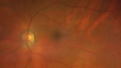 Lamellar Macular Hole - Evoluation over 5 years
65 year old man with Sturge weber and a choroidal hemangioma in the left eye.  (See other images under sturge weber on this website). Has ongoing problem with his left eye.  Now with Blurred vision in the right eye gradually worse the last few weeks.  He has had a vitrectomy in the right eye 4 years ago for floaters.  Laser for tears and cryo in the right eye 5 years ago. He is on Dorzolamide and Lumigan for glaucoma.
VA 20/32 OD, 20/40 OS
IOP 23 OD, 19 OS
