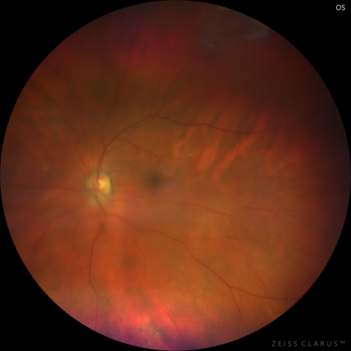 Lamellar Macular Hole - Evoluation over 5 years
65 year old man with Sturge weber and a choroidal hemangioma in the left eye.  (See other images under sturge weber on this website). Has ongoing problem with his left eye.  Now with Blurred vision in the right eye gradually worse the last few weeks.  He has had a vitrectomy in the right eye 4 years ago for floaters.  Laser for tears and cryo in the right eye 5 years ago. He is on Dorzolamide and Lumigan for glaucoma.
VA 20/32 OD, 20/40 OS
IOP 23 OD, 19 OS
