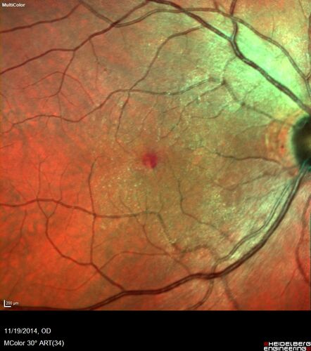 Lamellar Macular Hole - Evoluation over 5 years
65 year old man with Sturge weber and a choroidal hemangioma in the left eye.  (See other images under sturge weber on this website). Has ongoing problem with his left eye.  Now with Blurred vision in the right eye gradually worse the last few weeks.  He has had a vitrectomy in the right eye 4 years ago for floaters.  Laser for tears and cryo in the right eye 5 years ago. He is on Dorzolamide and Lumigan for glaucoma.
VA 20/32 OD, 20/40 OS
IOP 23 OD, 19 OS
