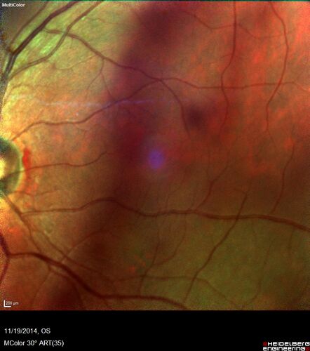 Lamellar Macular Hole - Evoluation over 5 years
65 year old man with Sturge weber and a choroidal hemangioma in the left eye.  (See other images under sturge weber on this website). Has ongoing problem with his left eye.  Now with Blurred vision in the right eye gradually worse the last few weeks.  He has had a vitrectomy in the right eye 4 years ago for floaters.  Laser for tears and cryo in the right eye 5 years ago. He is on Dorzolamide and Lumigan for glaucoma.
VA 20/32 OD, 20/40 OS
IOP 23 OD, 19 OS

