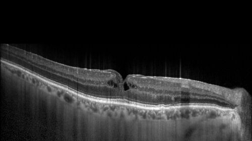 Lamellar Macular Hole - Evoluation over 5 years
65 year old man with Sturge weber and a choroidal hemangioma in the left eye.  (See other images under sturge weber on this website). Has ongoing problem with his left eye.  Now with Blurred vision in the right eye gradually worse the last few weeks.  He has had a vitrectomy in the right eye 4 years ago for floaters.  Laser for tears and cryo in the right eye 5 years ago. He is on Dorzolamide and Lumigan for glaucoma.
VA 20/32 OD, 20/40 OS
IOP 23 OD, 19 OS
