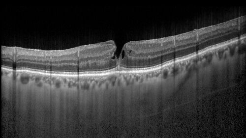 Lamellar Macular Hole - Evoluation over 5 years
65 year old man with Sturge weber and a choroidal hemangioma in the left eye.  (See other images under sturge weber on this website). Has ongoing problem with his left eye.  Now with Blurred vision in the right eye gradually worse the last few weeks.  He has had a vitrectomy in the right eye 4 years ago for floaters.  Laser for tears and cryo in the right eye 5 years ago. He is on Dorzolamide and Lumigan for glaucoma.
VA 20/32 OD, 20/40 OS
IOP 23 OD, 19 OS
