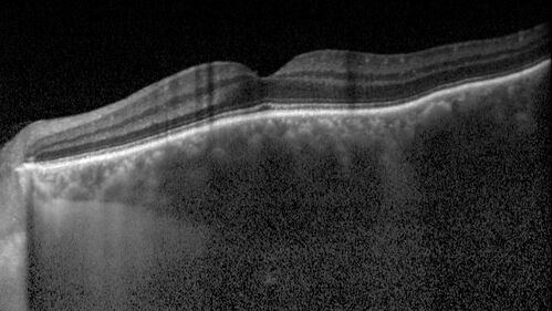 Lamellar Macular Hole - Evoluation over 5 years
65 year old man with Sturge weber and a choroidal hemangioma in the left eye.  (See other images under sturge weber on this website). Has ongoing problem with his left eye.  Now with Blurred vision in the right eye gradually worse the last few weeks.  He has had a vitrectomy in the right eye 4 years ago for floaters.  Laser for tears and cryo in the right eye 5 years ago. He is on Dorzolamide and Lumigan for glaucoma.
VA 20/32 OD, 20/40 OS
IOP 23 OD, 19 OS
