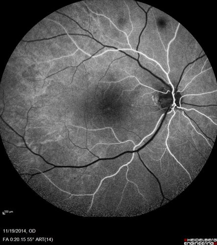 Lamellar Macular Hole - Evoluation over 5 years
65 year old man with Sturge weber and a choroidal hemangioma in the left eye.  (See other images under sturge weber on this website). Has ongoing problem with his left eye.  Now with Blurred vision in the right eye gradually worse the last few weeks.  He has had a vitrectomy in the right eye 4 years ago for floaters.  Laser for tears and cryo in the right eye 5 years ago. He is on Dorzolamide and Lumigan for glaucoma.
VA 20/32 OD, 20/40 OS
IOP 23 OD, 19 OS
