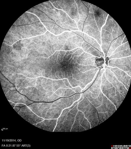 Lamellar Macular Hole - Evoluation over 5 years
65 year old man with Sturge weber and a choroidal hemangioma in the left eye.  (See other images under sturge weber on this website). Has ongoing problem with his left eye.  Now with Blurred vision in the right eye gradually worse the last few weeks.  He has had a vitrectomy in the right eye 4 years ago for floaters.  Laser for tears and cryo in the right eye 5 years ago. He is on Dorzolamide and Lumigan for glaucoma.
VA 20/32 OD, 20/40 OS
IOP 23 OD, 19 OS
