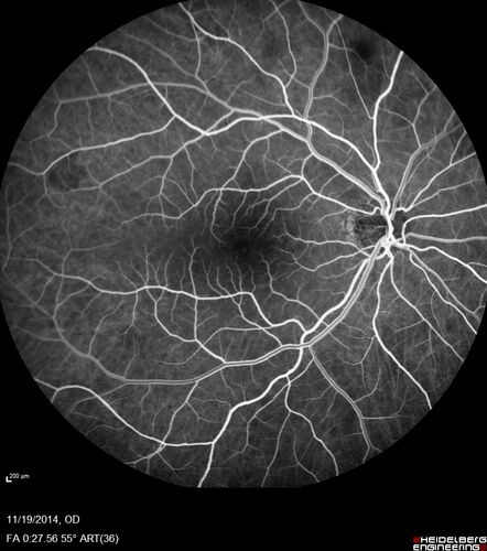 Lamellar Macular Hole - Evoluation over 5 years
65 year old man with Sturge weber and a choroidal hemangioma in the left eye.  (See other images under sturge weber on this website). Has ongoing problem with his left eye.  Now with Blurred vision in the right eye gradually worse the last few weeks.  He has had a vitrectomy in the right eye 4 years ago for floaters.  Laser for tears and cryo in the right eye 5 years ago. He is on Dorzolamide and Lumigan for glaucoma.
VA 20/32 OD, 20/40 OS
IOP 23 OD, 19 OS
