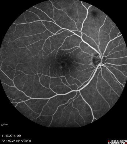 Lamellar Macular Hole - Evoluation over 5 years
65 year old man with Sturge weber and a choroidal hemangioma in the left eye.  (See other images under sturge weber on this website). Has ongoing problem with his left eye.  Now with Blurred vision in the right eye gradually worse the last few weeks.  He has had a vitrectomy in the right eye 4 years ago for floaters.  Laser for tears and cryo in the right eye 5 years ago. He is on Dorzolamide and Lumigan for glaucoma.
VA 20/32 OD, 20/40 OS
IOP 23 OD, 19 OS
