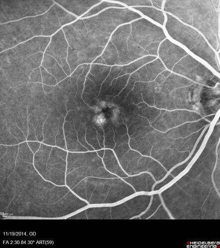 Lamellar Macular Hole - Evoluation over 5 years
65 year old man with Sturge weber and a choroidal hemangioma in the left eye.  (See other images under sturge weber on this website). Has ongoing problem with his left eye.  Now with Blurred vision in the right eye gradually worse the last few weeks.  He has had a vitrectomy in the right eye 4 years ago for floaters.  Laser for tears and cryo in the right eye 5 years ago. He is on Dorzolamide and Lumigan for glaucoma.
VA 20/32 OD, 20/40 OS
IOP 23 OD, 19 OS
