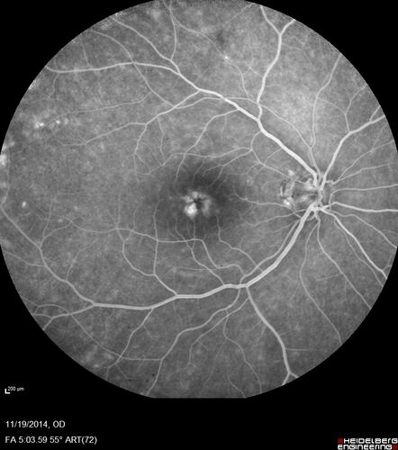 Lamellar Macular Hole - Evoluation over 5 years
65 year old man with Sturge weber and a choroidal hemangioma in the left eye.  (See other images under sturge weber on this website). Has ongoing problem with his left eye.  Now with Blurred vision in the right eye gradually worse the last few weeks.  He has had a vitrectomy in the right eye 4 years ago for floaters.  Laser for tears and cryo in the right eye 5 years ago. He is on Dorzolamide and Lumigan for glaucoma.
VA 20/32 OD, 20/40 OS
IOP 23 OD, 19 OS
