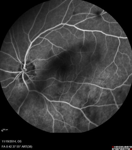 Lamellar Macular Hole - Evoluation over 5 years
65 year old man with Sturge weber and a choroidal hemangioma in the left eye.  (See other images under sturge weber on this website). Has ongoing problem with his left eye.  Now with Blurred vision in the right eye gradually worse the last few weeks.  He has had a vitrectomy in the right eye 4 years ago for floaters.  Laser for tears and cryo in the right eye 5 years ago. He is on Dorzolamide and Lumigan for glaucoma.
VA 20/32 OD, 20/40 OS
IOP 23 OD, 19 OS
