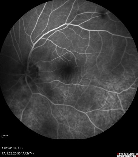 Lamellar Macular Hole - Evoluation over 5 years
65 year old man with Sturge weber and a choroidal hemangioma in the left eye.  (See other images under sturge weber on this website). Has ongoing problem with his left eye.  Now with Blurred vision in the right eye gradually worse the last few weeks.  He has had a vitrectomy in the right eye 4 years ago for floaters.  Laser for tears and cryo in the right eye 5 years ago. He is on Dorzolamide and Lumigan for glaucoma.
VA 20/32 OD, 20/40 OS
IOP 23 OD, 19 OS
