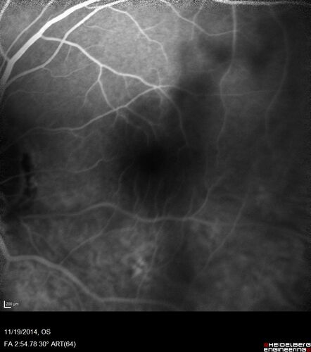 Lamellar Macular Hole - Evoluation over 5 years
65 year old man with Sturge weber and a choroidal hemangioma in the left eye.  (See other images under sturge weber on this website). Has ongoing problem with his left eye.  Now with Blurred vision in the right eye gradually worse the last few weeks.  He has had a vitrectomy in the right eye 4 years ago for floaters.  Laser for tears and cryo in the right eye 5 years ago. He is on Dorzolamide and Lumigan for glaucoma.
VA 20/32 OD, 20/40 OS
IOP 23 OD, 19 OS
