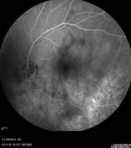 Lamellar Macular Hole - Evoluation over 5 years
65 year old man with Sturge weber and a choroidal hemangioma in the left eye.  (See other images under sturge weber on this website). Has ongoing problem with his left eye.  Now with Blurred vision in the right eye gradually worse the last few weeks.  He has had a vitrectomy in the right eye 4 years ago for floaters.  Laser for tears and cryo in the right eye 5 years ago. He is on Dorzolamide and Lumigan for glaucoma.
VA 20/32 OD, 20/40 OS
IOP 23 OD, 19 OS
