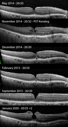 Lamellar Macular Hole - Evoluation over 5 years
65 year old man with Sturge weber and a choroidal hemangioma in the left eye.  (See other images under sturge weber on this website). Has ongoing problem with his left eye.  Now with Blurred vision in the right eye gradually worse the last few weeks.  He has had a vitrectomy in the right eye 4 years ago for floaters.  Laser for tears and cryo in the right eye 5 years ago. He is on Dorzolamide and Lumigan for glaucoma.
VA 20/32 OD, 20/40 OS
IOP 23 OD, 19 OS
