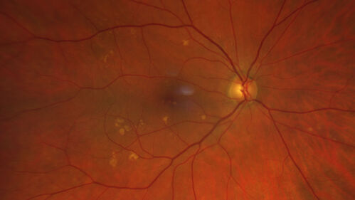 Large Hyper-reflective drusen in age-related macular degeneration
69 year old healthy woman with 20/20 vision and no visual complaints
