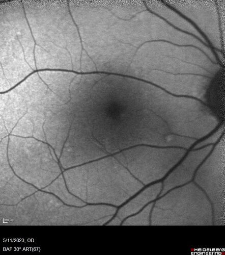 Large Hyper-reflective drusen in age-related macular degeneration
69 year old healthy woman with 20/20 vision and no visual complaints
