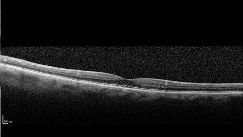 Large Hyper-reflective drusen in age-related macular degeneration
69 year old healthy woman with 20/20 vision and no visual complaints
