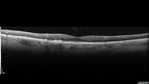 Large Hyper-reflective drusen in age-related macular degeneration
69 year old healthy woman with 20/20 vision and no visual complaints
