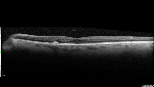 Large Hyper-reflective drusen in age-related macular degeneration
69 year old healthy woman with 20/20 vision and no visual complaints
