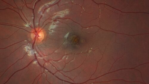 Laser pointer maculopathy
11 year old male When school started the patient noticed that he was having trouble reading and seeing out of both eyes. There are no retinal diseases in the family.
VA OD: sc20/25
VA OS: sc20/40 
TP: OD:19 OS:18 

The FOBSERD ZK-9318 laser pointer is a long range green beam high power flashlight. It has an average power of 60-90 mw. 
You can buy the ZK-9318 laser pointer on Amazon

I also found this:
The FOBSERD ZK-9318 laser pointer is a class III laser with a 532nm wavelength and can be seen up to 1 mile away. It has a maximum power output of 5mW and creates a low-power visible laser beam.

One review on amazon says this:
 Powerful
By Savvy Logic in the United States on March 17, 2023
I measured the wattage at about 150 MW on an optical Power Meter

