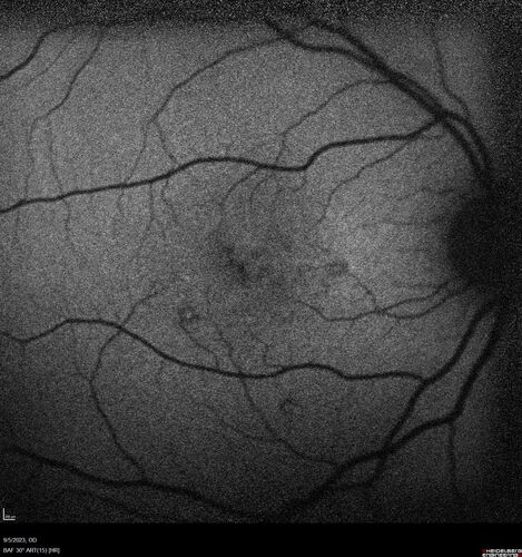 Laser pointer maculopathy
11 year old male When school started the patient noticed that he was having trouble reading and seeing out of both eyes. There are no retinal diseases in the family.
VA OD: sc20/25
VA OS: sc20/40 
TP: OD:19 OS:18 

The FOBSERD ZK-9318 laser pointer is a long range green beam high power flashlight. It has an average power of 60-90 mw. 
You can buy the ZK-9318 laser pointer on Amazon

I also found this:
The FOBSERD ZK-9318 laser pointer is a class III laser with a 532nm wavelength and can be seen up to 1 mile away. It has a maximum power output of 5mW and creates a low-power visible laser beam.

One review on amazon says this:
 Powerful
By Savvy Logic in the United States on March 17, 2023
I measured the wattage at about 150 MW on an optical Power Meter
