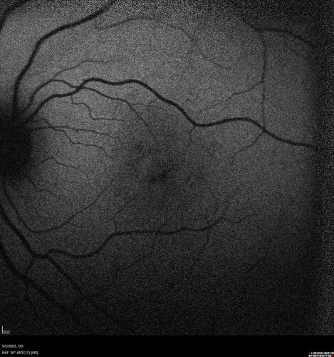 Laser pointer maculopathy
11 year old male When school started the patient noticed that he was having trouble reading and seeing out of both eyes. There are no retinal diseases in the family.
VA OD: sc20/25
VA OS: sc20/40 
TP: OD:19 OS:18 

The FOBSERD ZK-9318 laser pointer is a long range green beam high power flashlight. It has an average power of 60-90 mw. 
You can buy the ZK-9318 laser pointer on Amazon

I also found this:
The FOBSERD ZK-9318 laser pointer is a class III laser with a 532nm wavelength and can be seen up to 1 mile away. It has a maximum power output of 5mW and creates a low-power visible laser beam.

One review on amazon says this:
 Powerful
By Savvy Logic in the United States on March 17, 2023
I measured the wattage at about 150 MW on an optical Power Meter
