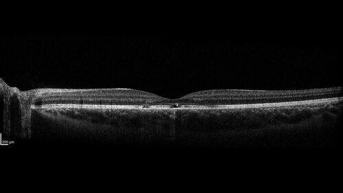 Laser pointer maculopathy
11 year old male When school started the patient noticed that he was having trouble reading and seeing out of both eyes. There are no retinal diseases in the family.
VA OD: sc20/25
VA OS: sc20/40 
TP: OD:19 OS:18 

The FOBSERD ZK-9318 laser pointer is a long range green beam high power flashlight. It has an average power of 60-90 mw. 
You can buy the ZK-9318 laser pointer on Amazon

I also found this:
The FOBSERD ZK-9318 laser pointer is a class III laser with a 532nm wavelength and can be seen up to 1 mile away. It has a maximum power output of 5mW and creates a low-power visible laser beam.

One review on amazon says this:
 Powerful
By Savvy Logic in the United States on March 17, 2023
I measured the wattage at about 150 MW on an optical Power Meter
