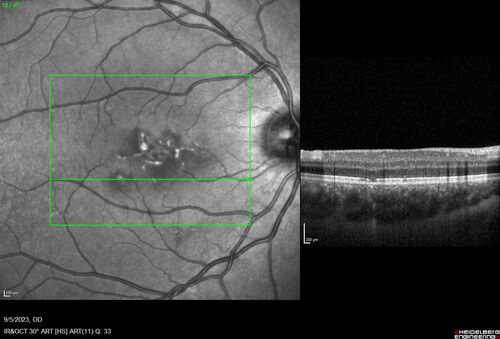 Laser pointer maculopathy
11 year old male When school started the patient noticed that he was having trouble reading and seeing out of both eyes. There are no retinal diseases in the family.
VA OD: sc20/25
VA OS: sc20/40 
TP: OD:19 OS:18 

The FOBSERD ZK-9318 laser pointer is a long range green beam high power flashlight. It has an average power of 60-90 mw. 
You can buy the ZK-9318 laser pointer on Amazon

I also found this:
The FOBSERD ZK-9318 laser pointer is a class III laser with a 532nm wavelength and can be seen up to 1 mile away. It has a maximum power output of 5mW and creates a low-power visible laser beam.

One review on amazon says this:
 Powerful
By Savvy Logic in the United States on March 17, 2023
I measured the wattage at about 150 MW on an optical Power Meter
