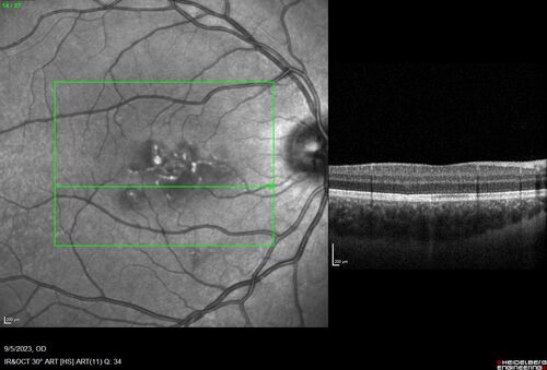 Laser pointer maculopathy
11 year old male When school started the patient noticed that he was having trouble reading and seeing out of both eyes. There are no retinal diseases in the family.
VA OD: sc20/25
VA OS: sc20/40 
TP: OD:19 OS:18 

The FOBSERD ZK-9318 laser pointer is a long range green beam high power flashlight. It has an average power of 60-90 mw. 
You can buy the ZK-9318 laser pointer on Amazon

I also found this:
The FOBSERD ZK-9318 laser pointer is a class III laser with a 532nm wavelength and can be seen up to 1 mile away. It has a maximum power output of 5mW and creates a low-power visible laser beam.

One review on amazon says this:
 Powerful
By Savvy Logic in the United States on March 17, 2023
I measured the wattage at about 150 MW on an optical Power Meter
