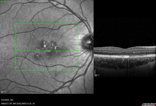 Laser pointer maculopathy
11 year old male When school started the patient noticed that he was having trouble reading and seeing out of both eyes. There are no retinal diseases in the family.
VA OD: sc20/25
VA OS: sc20/40 
TP: OD:19 OS:18 

The FOBSERD ZK-9318 laser pointer is a long range green beam high power flashlight. It has an average power of 60-90 mw. 
You can buy the ZK-9318 laser pointer on Amazon

I also found this:
The FOBSERD ZK-9318 laser pointer is a class III laser with a 532nm wavelength and can be seen up to 1 mile away. It has a maximum power output of 5mW and creates a low-power visible laser beam.

One review on amazon says this:
 Powerful
By Savvy Logic in the United States on March 17, 2023
I measured the wattage at about 150 MW on an optical Power Meter
