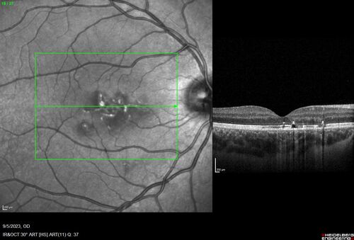 Laser pointer maculopathy
11 year old male When school started the patient noticed that he was having trouble reading and seeing out of both eyes. There are no retinal diseases in the family.
VA OD: sc20/25
VA OS: sc20/40 
TP: OD:19 OS:18 

The FOBSERD ZK-9318 laser pointer is a long range green beam high power flashlight. It has an average power of 60-90 mw. 
You can buy the ZK-9318 laser pointer on Amazon

I also found this:
The FOBSERD ZK-9318 laser pointer is a class III laser with a 532nm wavelength and can be seen up to 1 mile away. It has a maximum power output of 5mW and creates a low-power visible laser beam.

One review on amazon says this:
 Powerful
By Savvy Logic in the United States on March 17, 2023
I measured the wattage at about 150 MW on an optical Power Meter
